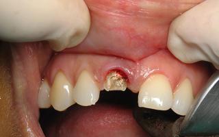 Odstránenie molárneho zuba Ako rýchlo odstrániť zuby