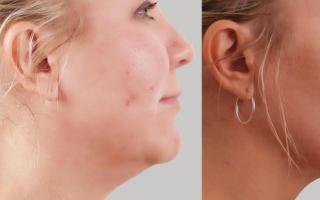 Sagging cheeks: causes of the phenomenon, prevention, ways to tighten them at home. What they do to tighten their cheeks